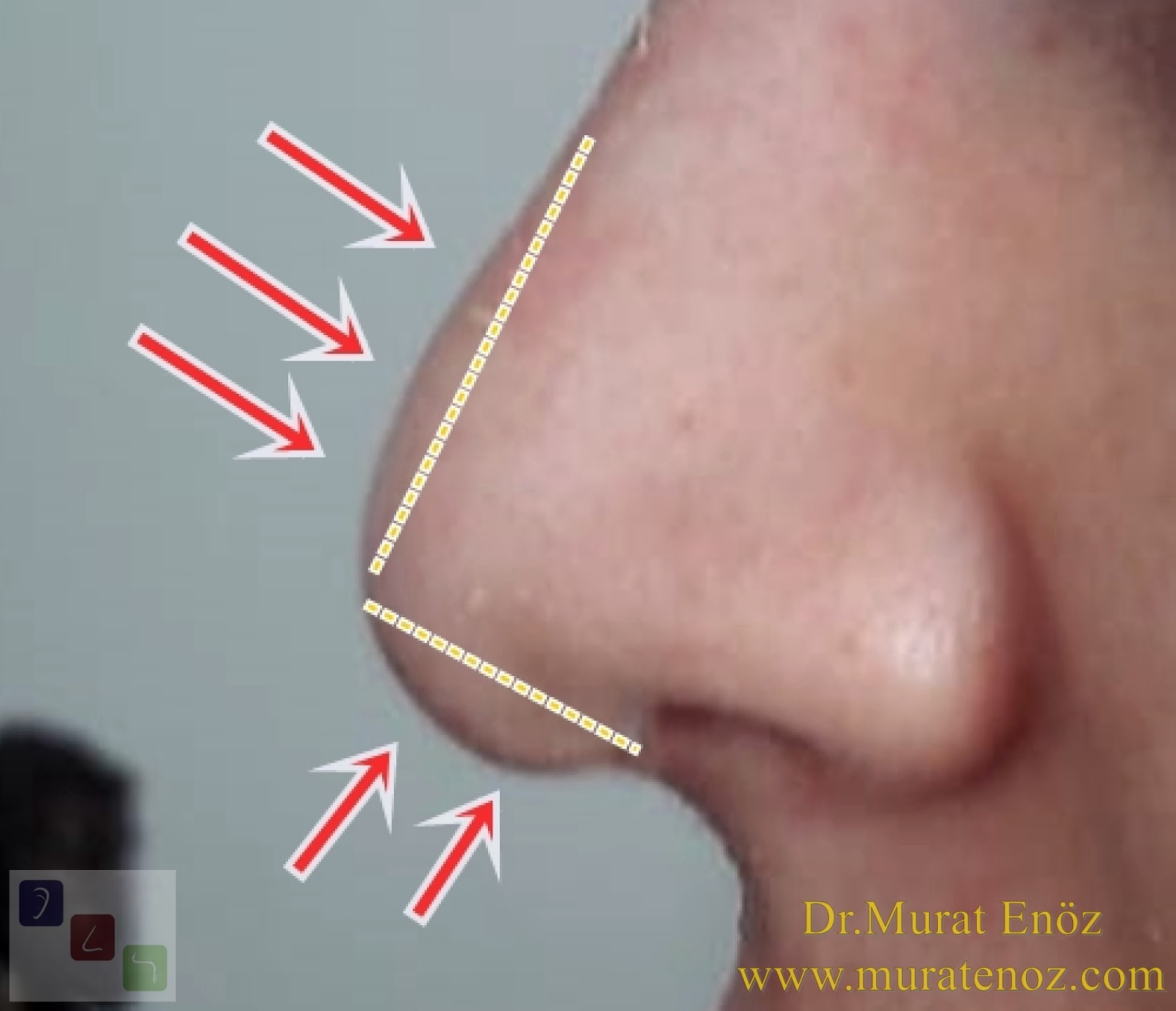 rhinoplasty post-surgery