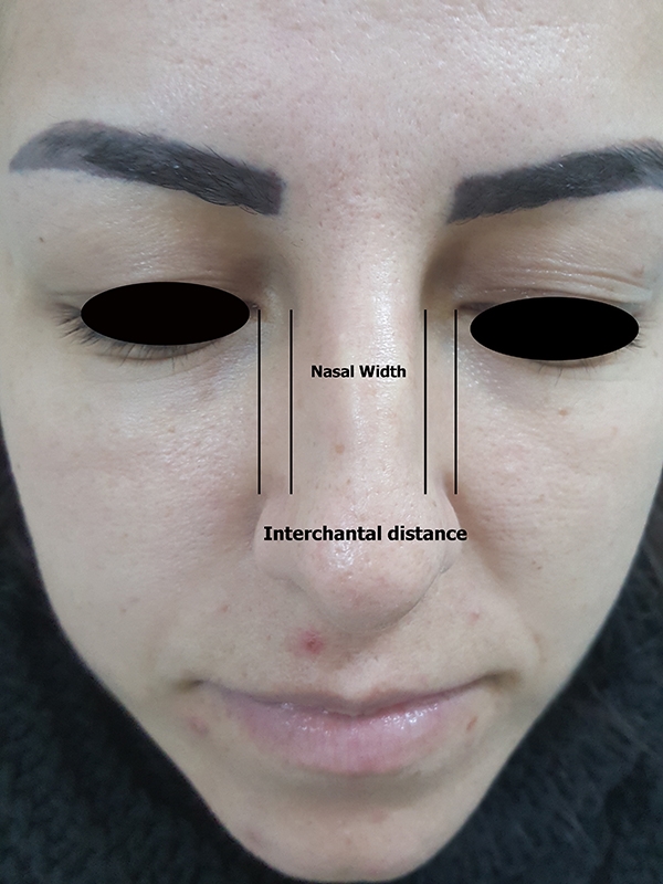 rhinoplasty post-surgery