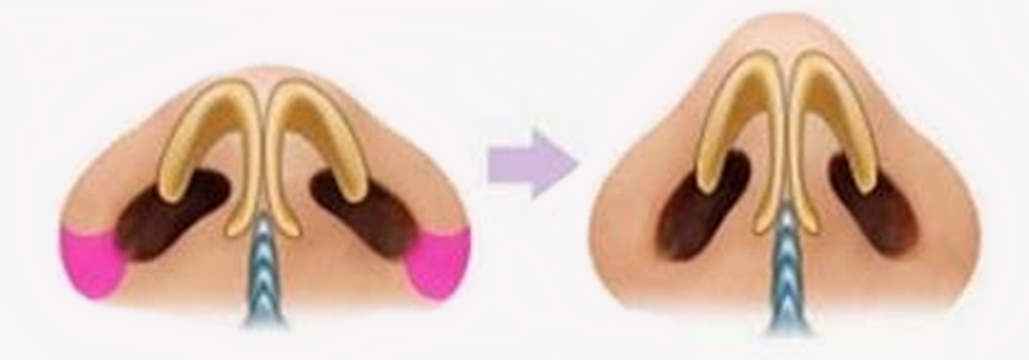 closed nose job