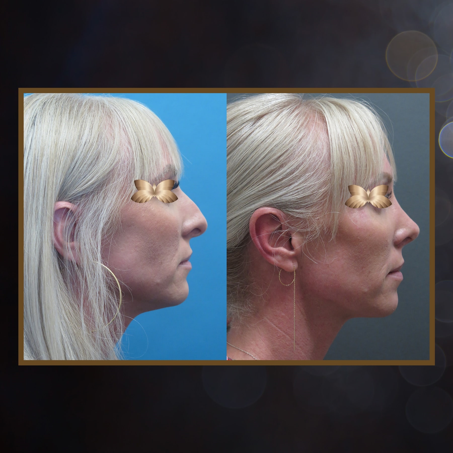 closed nose job