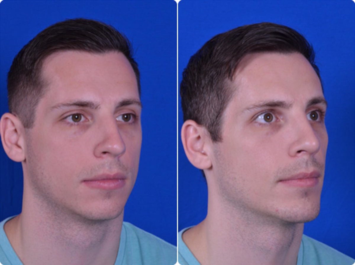 closed nose job