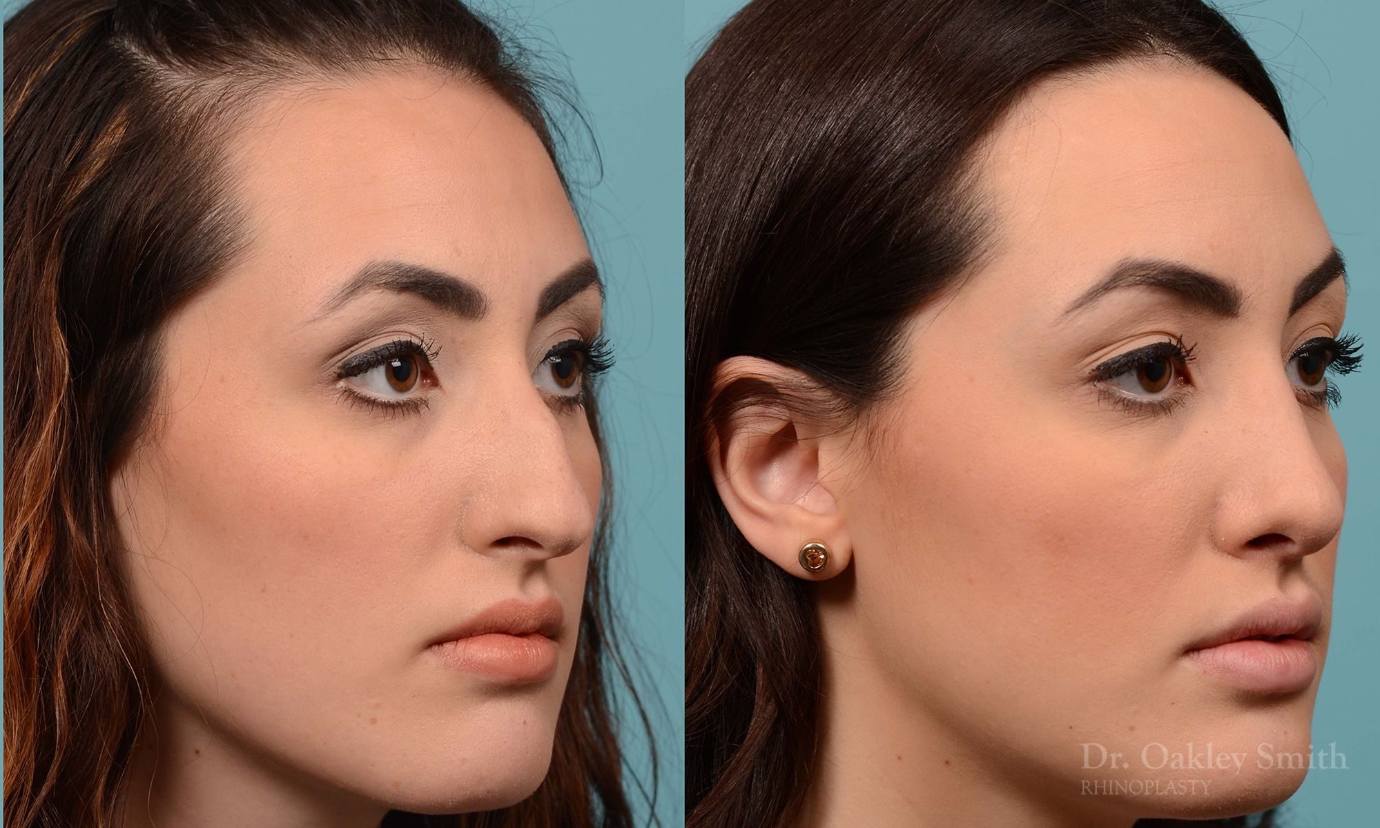 closed nose surgery