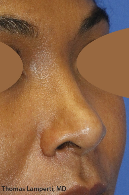 closed nose surgery