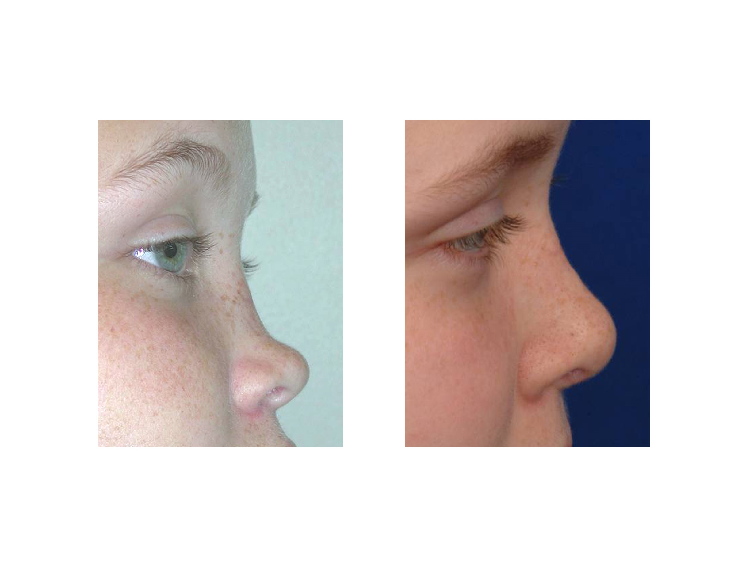 closed nose surgery